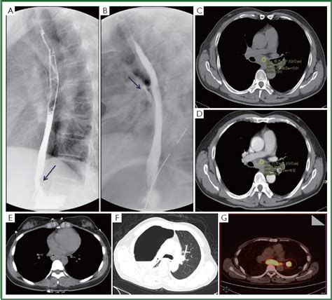 Surgical Outcome Of Esophageal Tuberculosis Secondary To Mediastinal