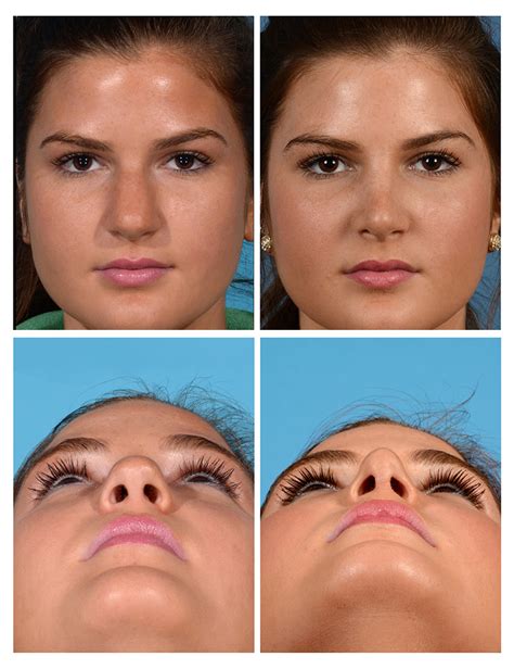 Bulbous Tip Nose Job Before And After Cosmetic Rhinoplasty For A