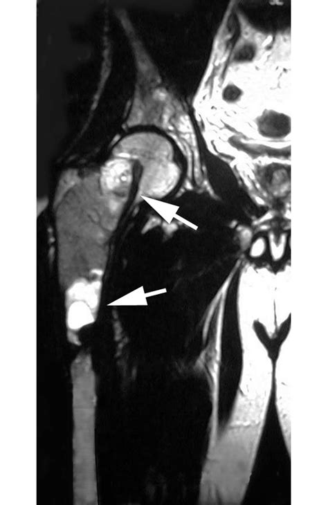 Coronal Fat Suppressed T2 Weighted Mri Scan Of The Proximal Femur The