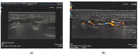 Clinics And Practice Free Full Text Arterial Thrombosis In An Unusual Site Ulnar Artery