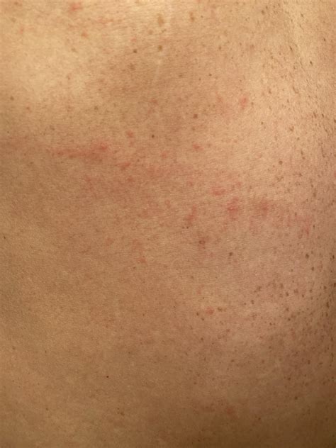 Is This Scabies I Have Had This Rash On And Off For 4 Months No One