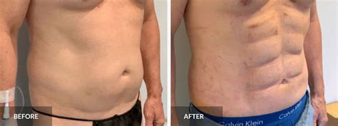 Liposuction With Abdominal Etching Cosmetic Surgery Tips