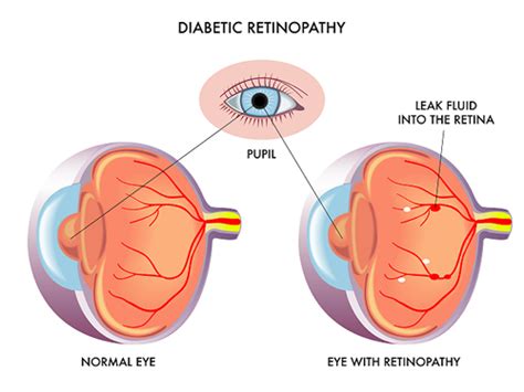 Diabetic Retinopathy Eye Care Surgery Center