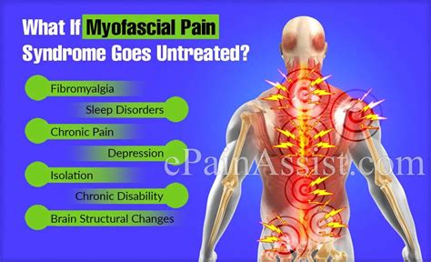 What Is Myofascial Pain Cares Healthy