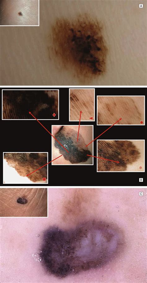 Examples Of Dermoscopic Features Detected In Acral Melanomas A