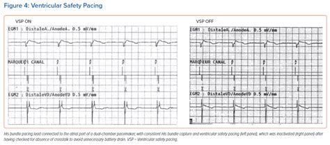 Ventricular Safety Pacing Radcliffe Cardiology