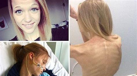 Una Joven Cae En La Anorexia Inspirada En Selfies Que Muestran La