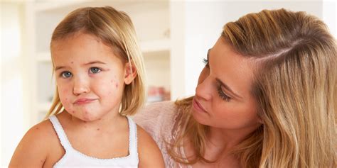 Chicken Pox Symptoms And Treatments Huffpost Uk