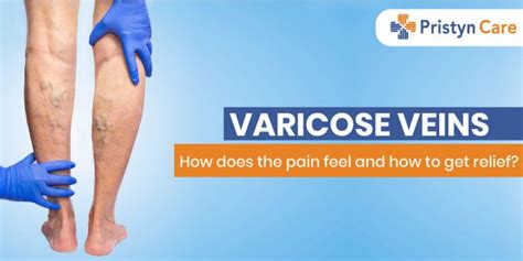 Varicose Veins How Does The Pain Feel And How To Get Relief Pristyn