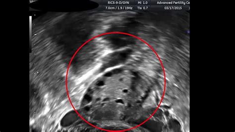 Antral Follicle Count Ultrasound