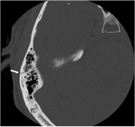 Delayed Onset Facial Palsy After Temporal Bone Fracture A Case Series