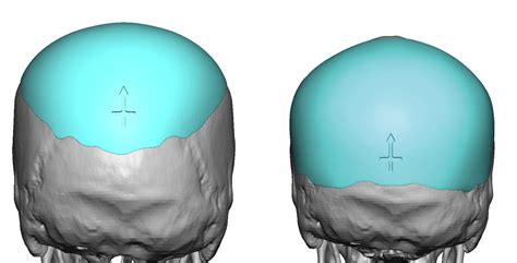 Plastic Surgery Case Study Custom Skull Implant Replacement For