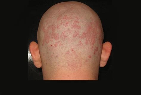 The Many Manifestations Of Eczema
