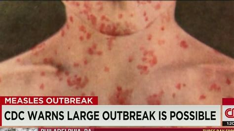 Measles Case Reported In Another State Cnn