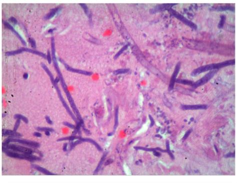It's caused by a group of molds called mucormycetes and often affects the sinuses, lungs, skin, and brain. A tip from the nose: rhinocerebral mucormycosis in a ...
