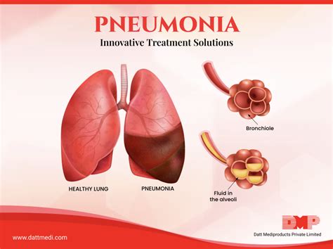 Pneumonia And Innovative Treatment Solutions Blog By Dmp