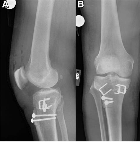 Anterior Closing Wedge Proximal Tibial Osteotomy For Slope Correction