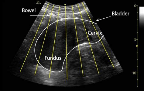 Pitfall Retroverted Uterus Critical Care Sonography