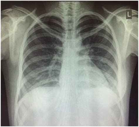 Erect Chest X Ray Demonstrating Subdiaphragmatic Free Air Download