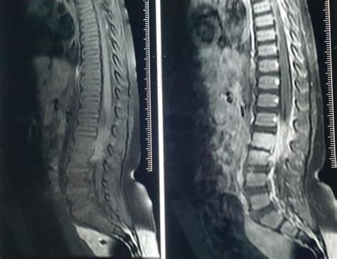 Mri Lumbosacral Sagittal T1 After Gadolinium Injection Showing