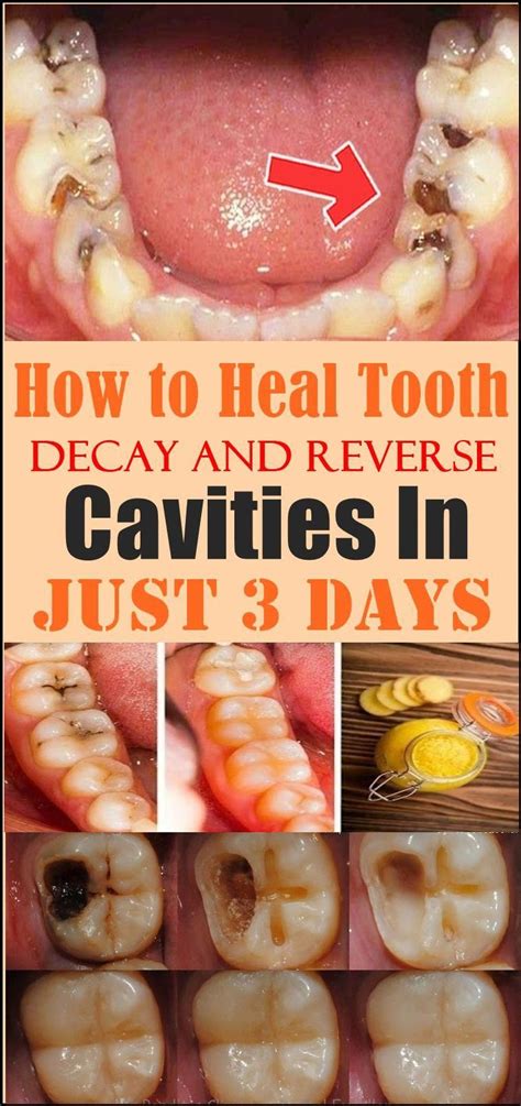 Body Remedy In 2020 Reverse Cavities Tooth Decay Dental Health Care