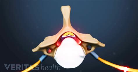 Treatment Options For Synovial Cysts