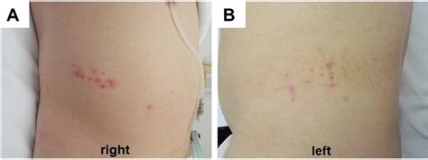 Bilateral Zoster Rash In The T11 Dermatome Notes A Grouped Vesicular
