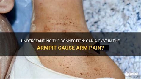 Understanding The Connection Can A Cyst In The Armpit Cause Arm Pain