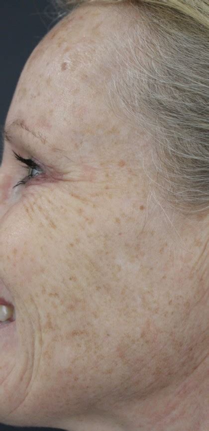Patient 14816 Skin Laxity Before And After Photos Santa Monica Plastic Surgery Gallery Los
