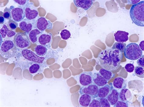 Hepatosplenic T Cell Lymphoma 1