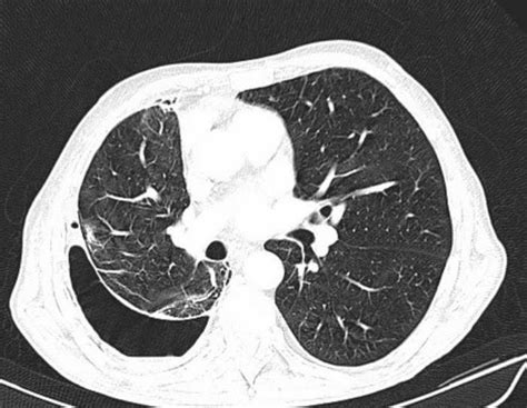 Get patient & product information here. Pneumothorax ex vacuo: Post-thoracentesis pneumothorax in ...