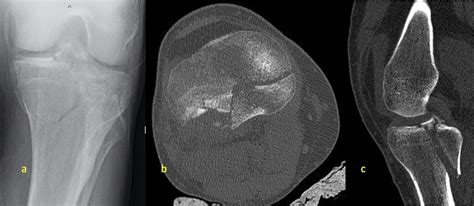 Meniscal Entrapment After Tibial Plateau Fracture And Fixati Jbjs