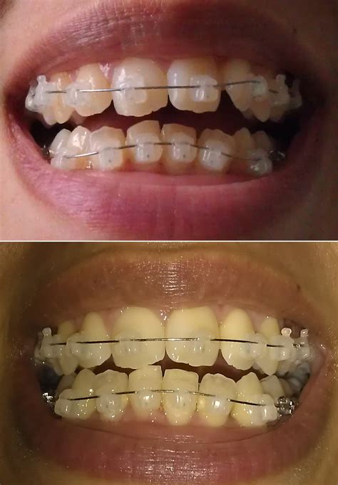My Damon Clear Braces Week 7 Before And After Pictures