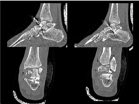 Post Orpp Ct Scan Showing The Talar Body Fracture Through The Talar