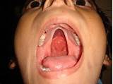 Cleft Palate Roof Of Mouth Photos