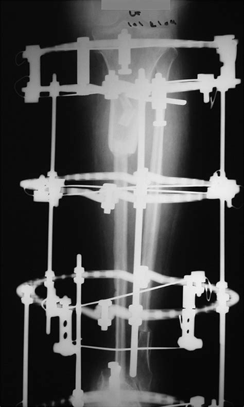 Limb Salvage For Osteosarcoma Of The Distal Tibia With Resection