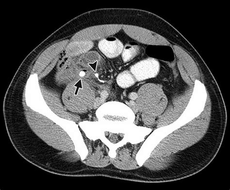 Stump Appendicitis Clinical And Ct Findings Ajr