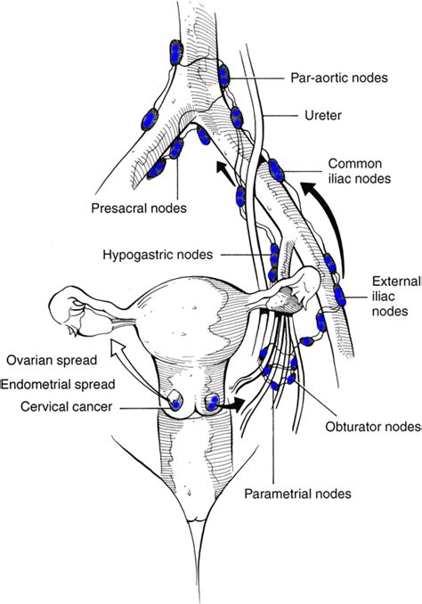 Cervical Cancer That Has Spread To The Lymph Nodes Cancerwalls