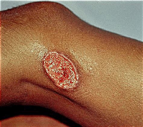 Cutaneous Leishmaniasis An Ulcerated Plaque With Indurated Border
