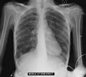 This web site looks at the. Viewing playlist: Favourite chest cases | Radiopaedia.org