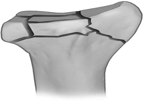 Fixation Of Distal Radius Fractures Using A Fragment Specifi