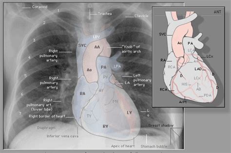 This imaging method can also check how a patient is responding to specific treatments. Labeled chest x-ray (CXR) | Cardiac anatomy, Radiology ...