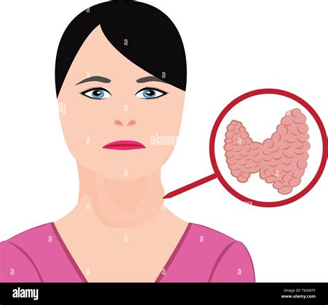 Goiter Thyroid Disease Endocrine Disfunction Vector Illustration On A