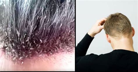 The Most Disgusting Head Lice Infestation You Will Ever See Thatviralfeed