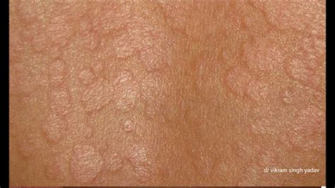 This fungus, called malessizia furfur, is a type of yeast that naturally. Diagnosis & Treatment Of Tinea Versicolor - YouTube