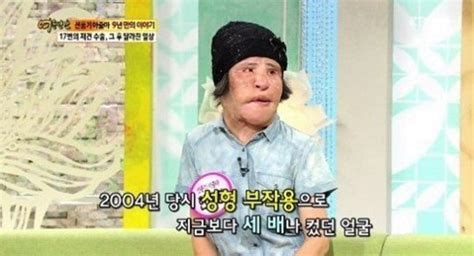 성형부작용 선풍기 아줌마 한혜경씨 15일 별세