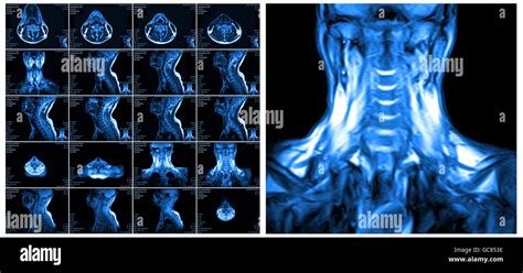 Magnetic Resonance Imaging Of The Cervical Spine Stock Photo Alamy