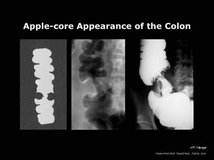 Now that apples are coming into season, it should be easy to eat at least one of these staple tree fruits per day. Apple-core appearance of the colon | Image | Radiopaedia.org