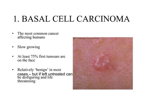 Ppt 1 Basal Cell Carcinoma Powerpoint Presentation Free Download