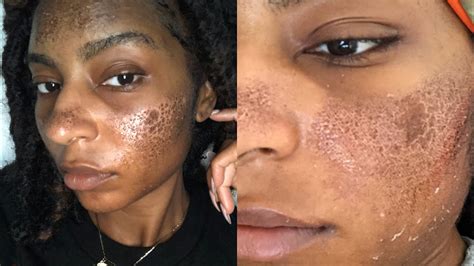 How I Ruined My Skin Burned Scarring And Hyperpigmentation Fraxel